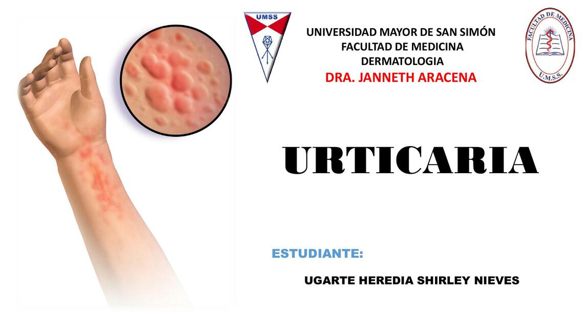 Urticaria