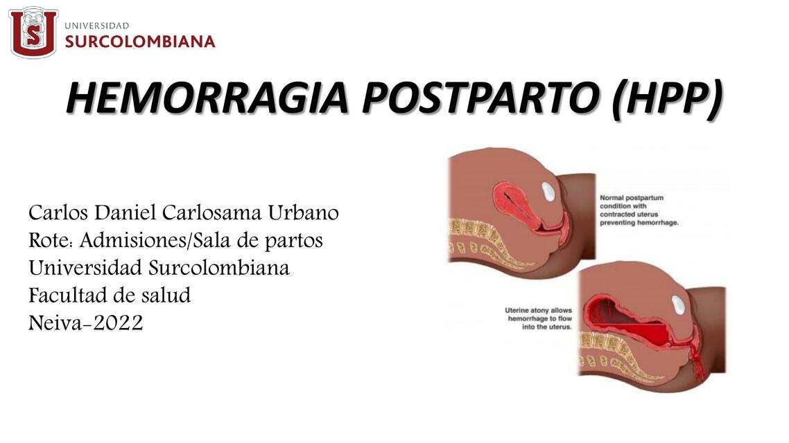 Hemorragia Postparto