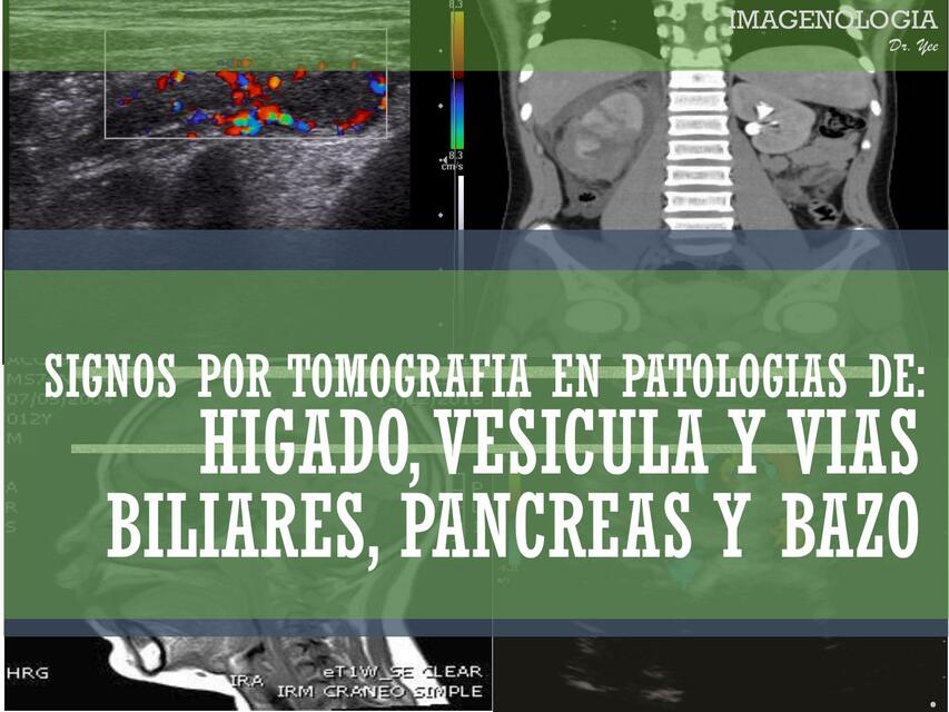 Signos por Tomografía en Patologías de: Hígado, Vesícula y Vías Biliares, Páncreas y Bazo 