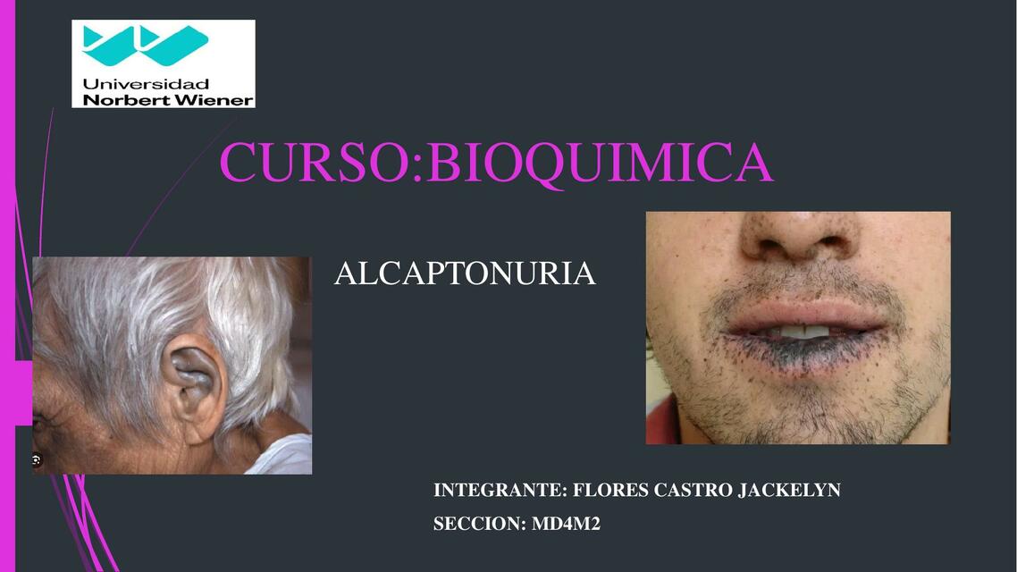 Producto  3 Alcaptonuria 