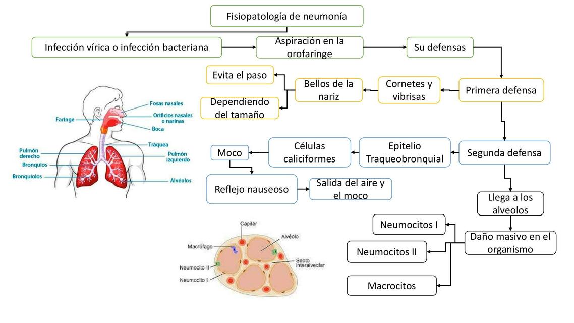 Neumonia