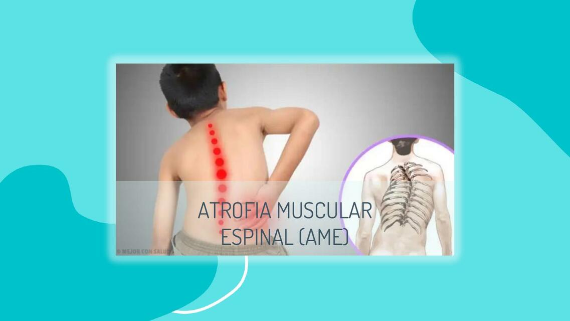 Atrofia muscular espinal 