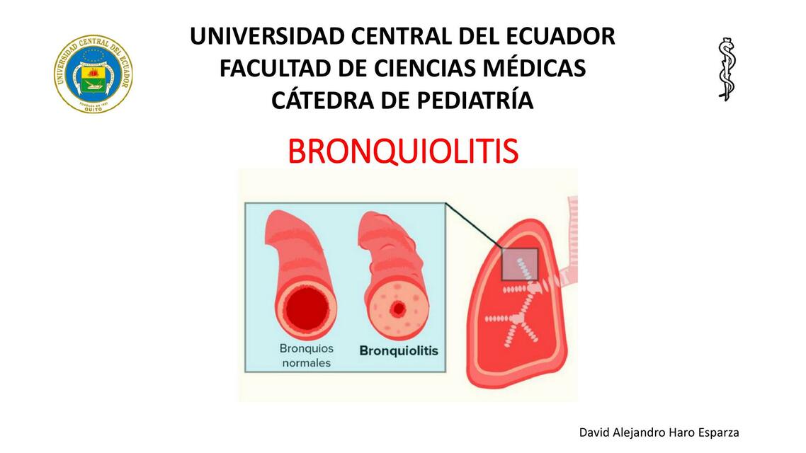 Bronquiolitis