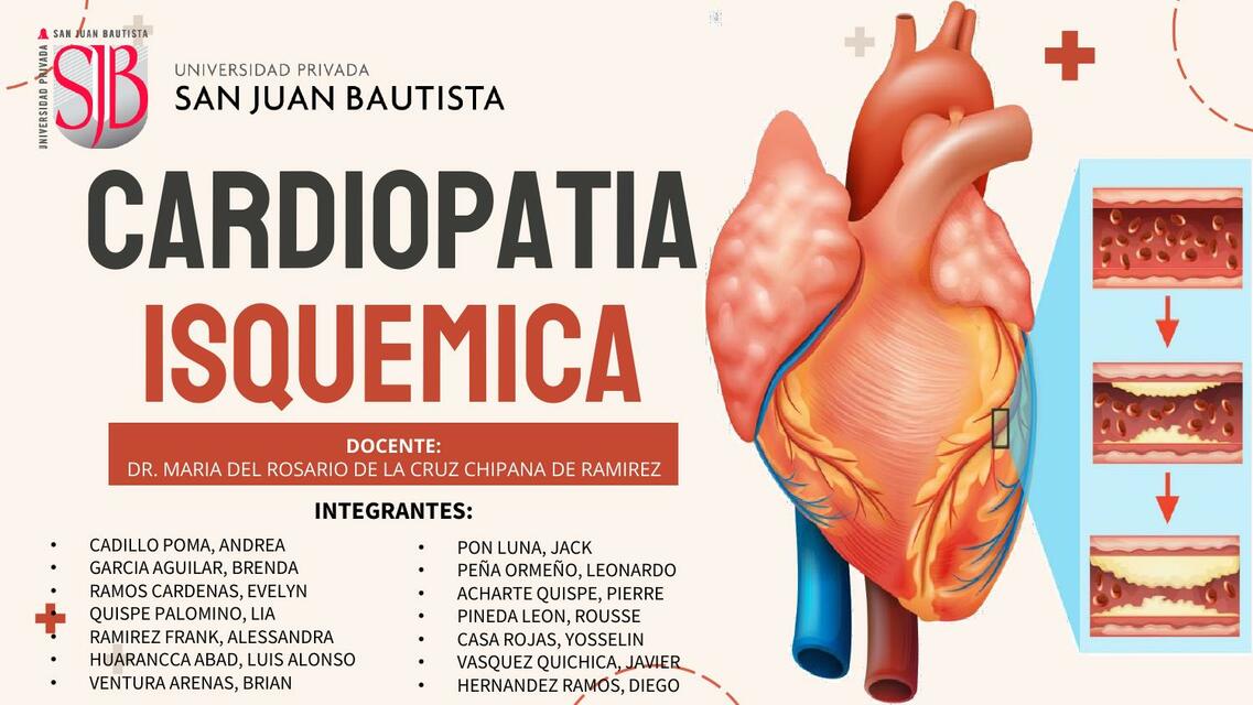 Cardiopatia isquemica