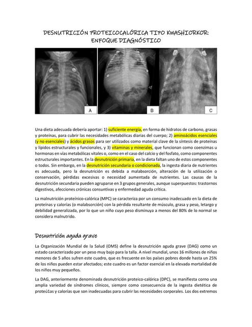 Desnutrición proteicocalórica tipo kwashiorkor