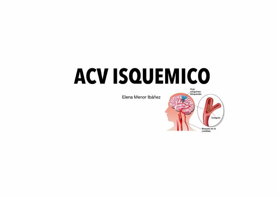 ACV Isquemica