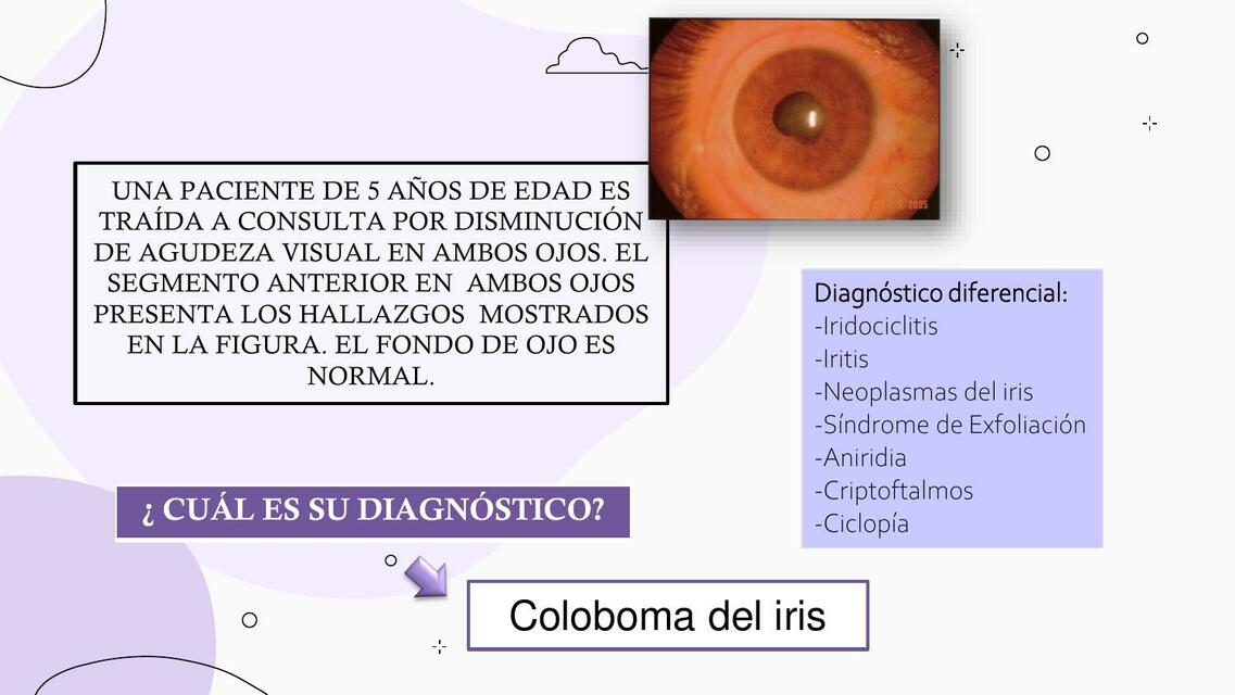 Coloboma