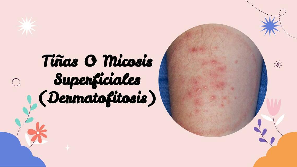 Micosis superficiales y profundas 