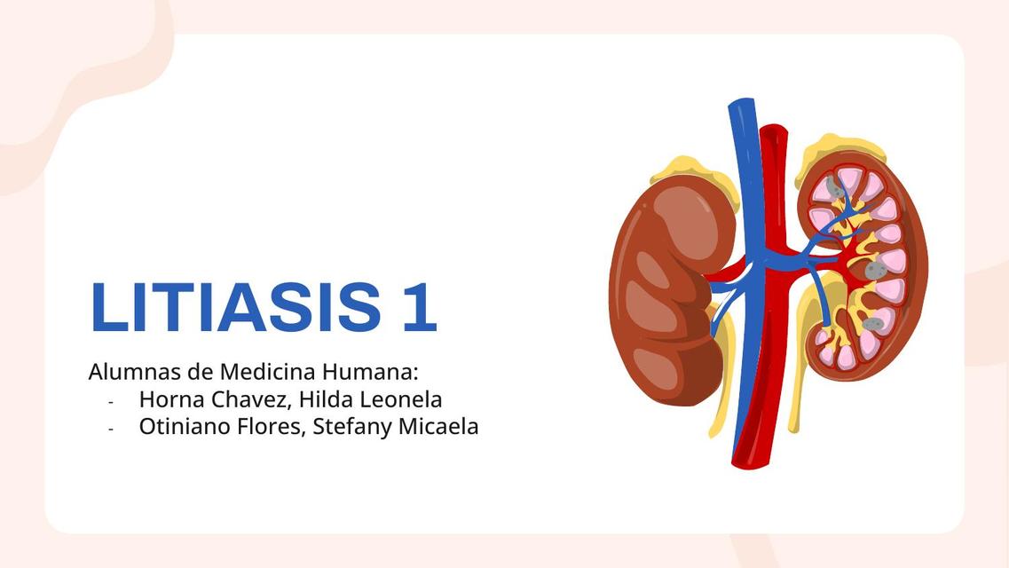 Litiasis 1 