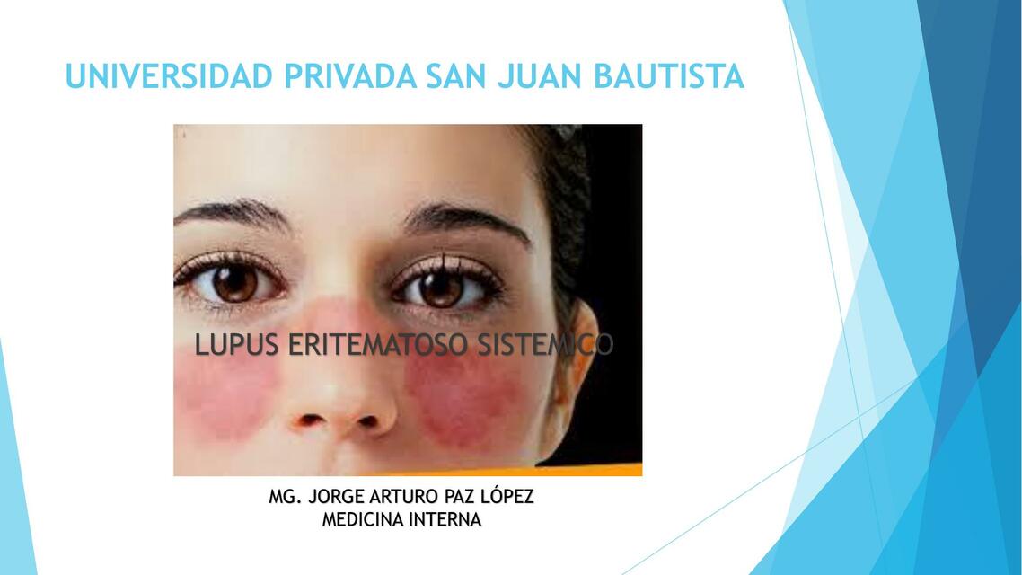 Lupus Eritematoso Sistémico 