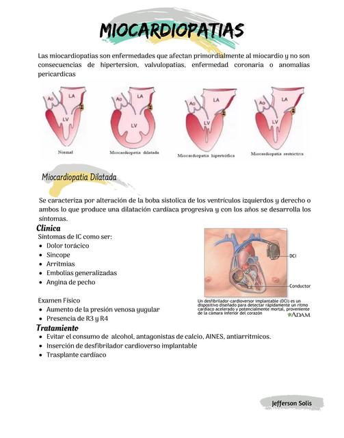 Miocardiopatías