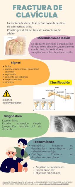 Fractura  de clavícula