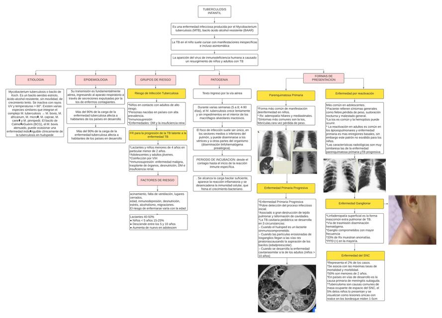 Tuberculosis Infantil 