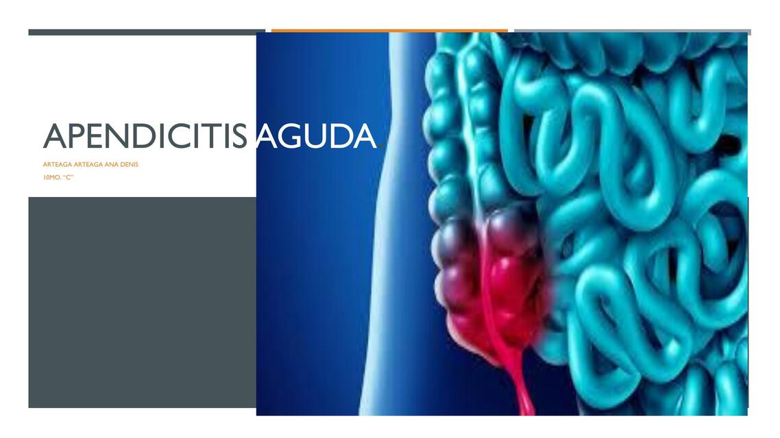 Apendicitis Aguda 