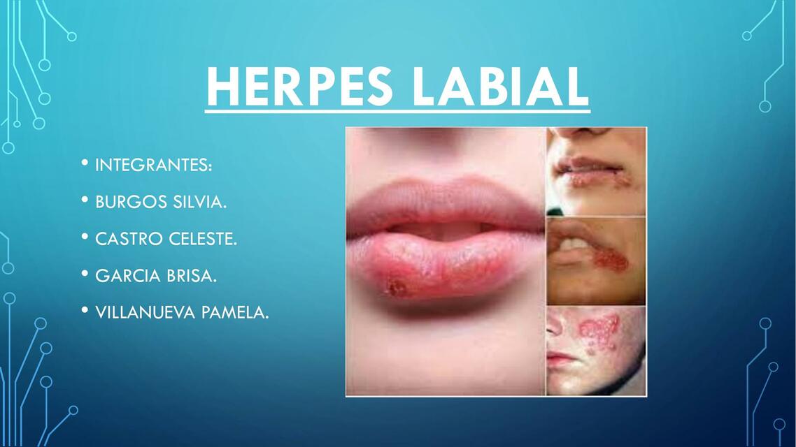 Herpes Labial 