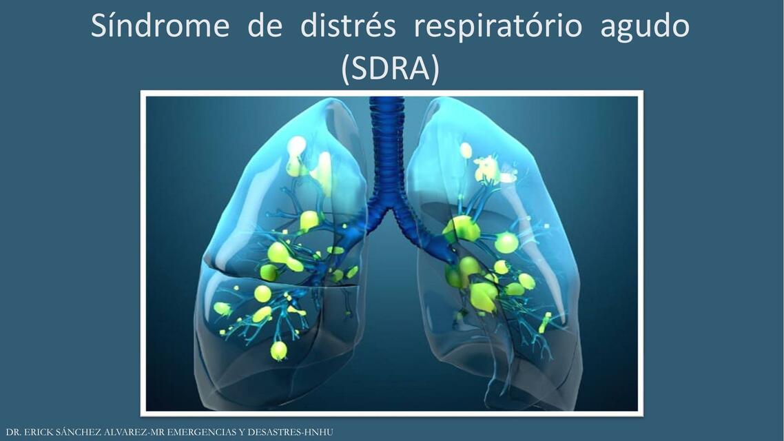 SDRA