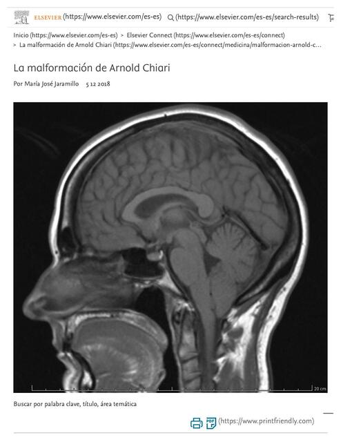 La malformación de Arnold Chiari 