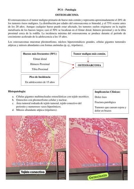 Osteosarcoma 