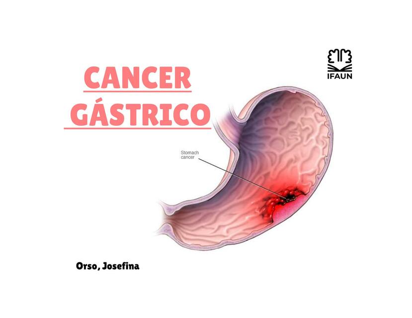 Cáncer Gástrico 