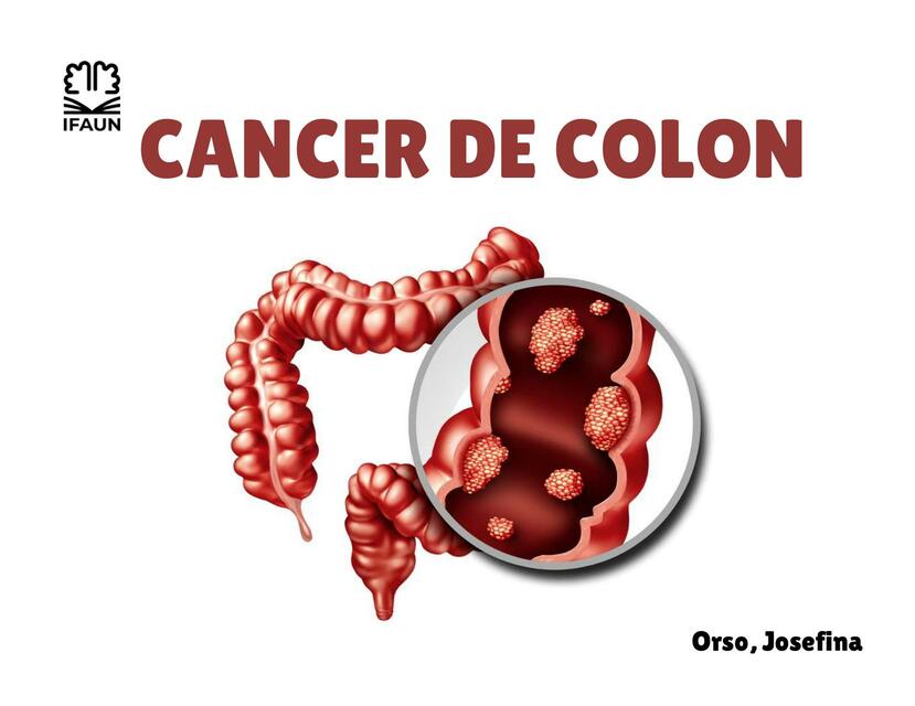 Cáncer de Colon 