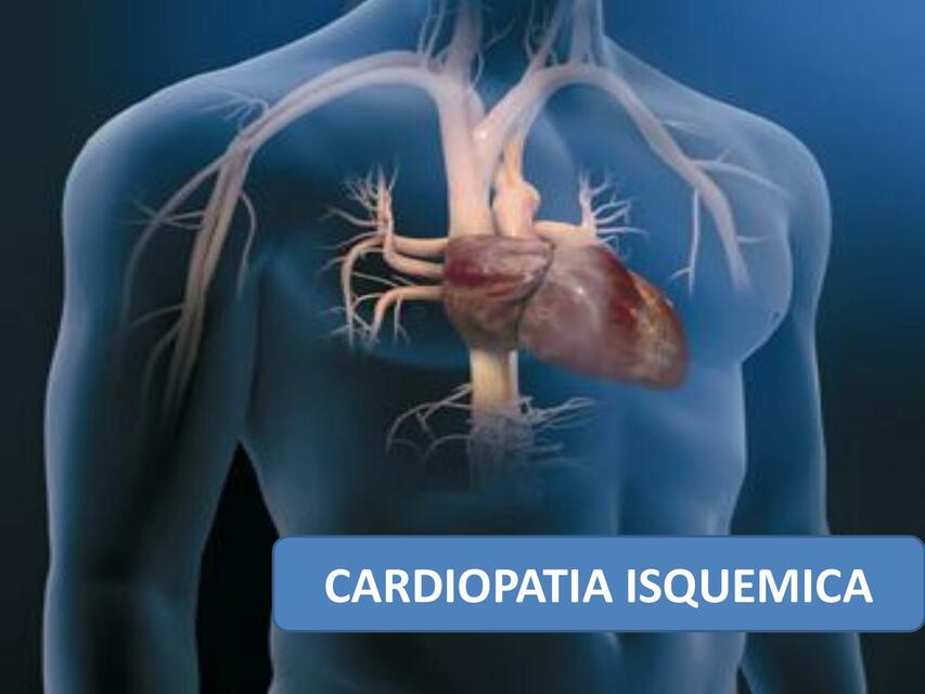 Cardiopatía Isquémica 