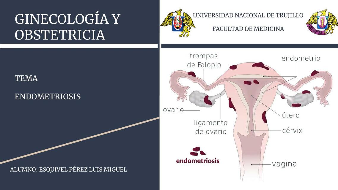 Endometriosis