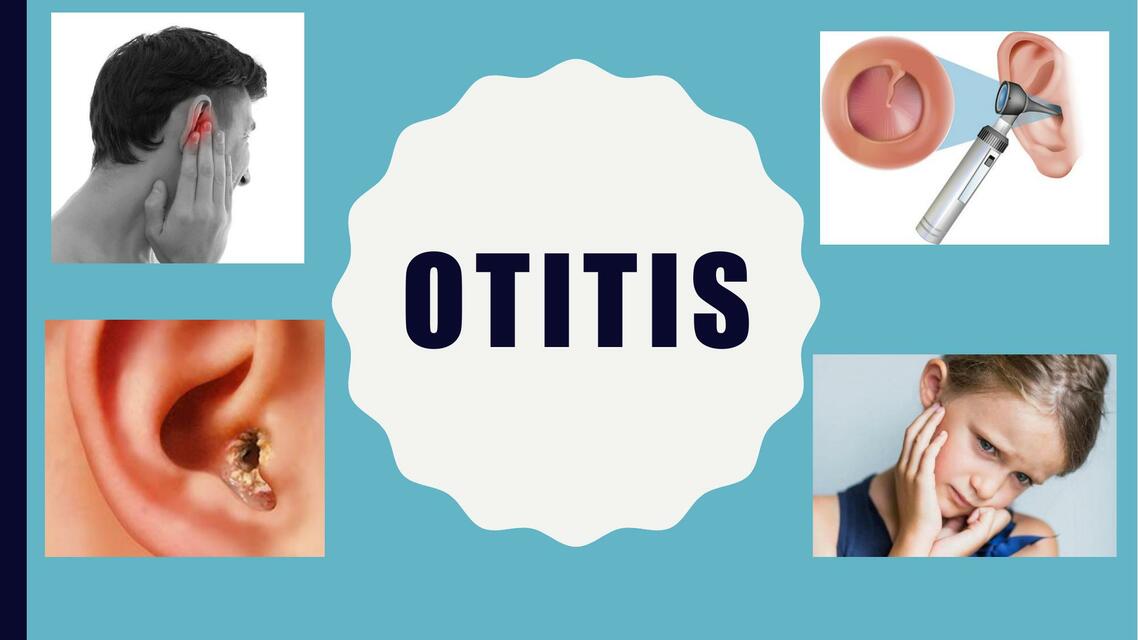 Otitis 