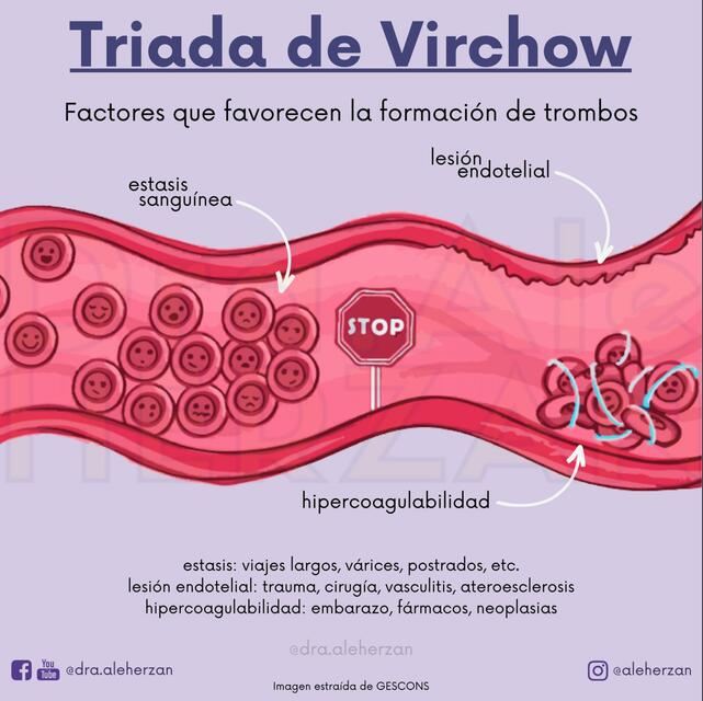 TRIADA DE VIRCHOW Dra Ale Herzan uDocz