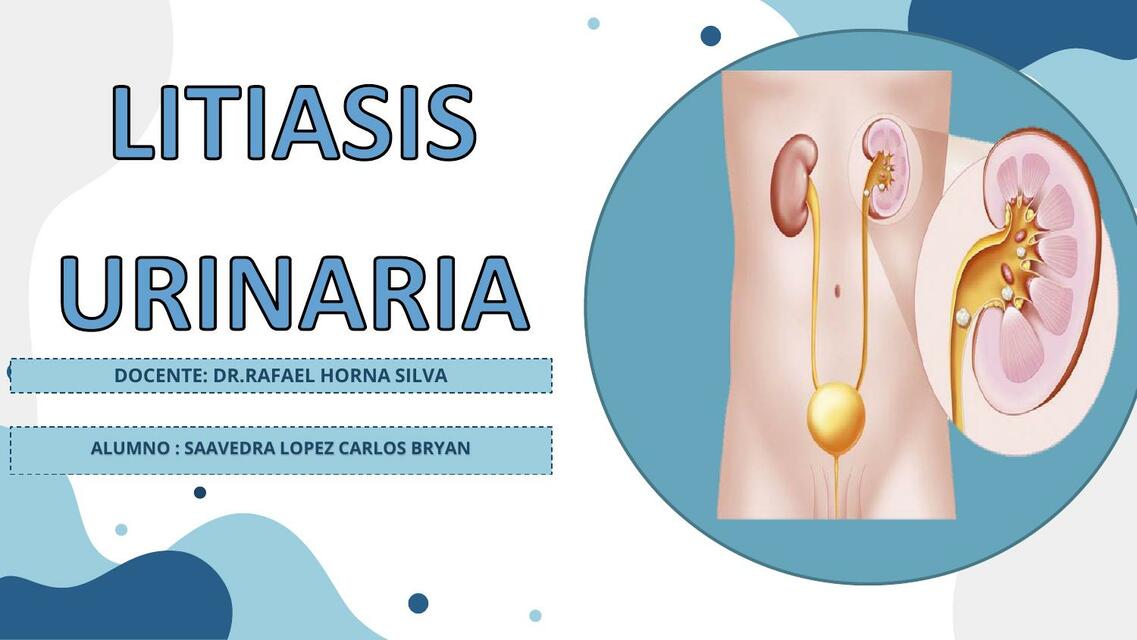 Litiasis Urinaria