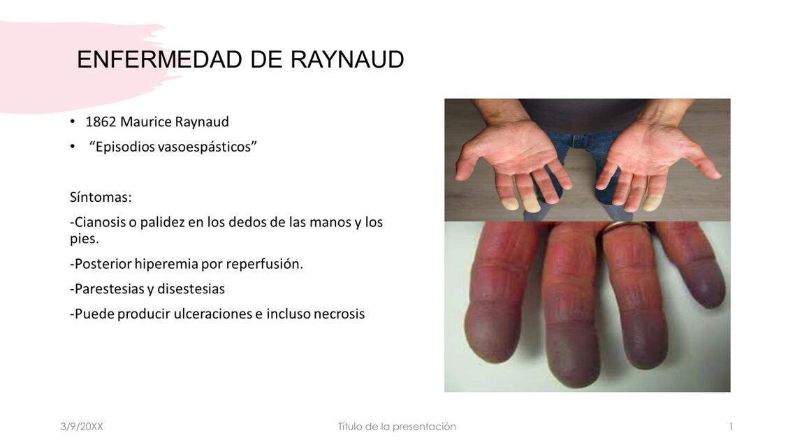 Enfermedad de Raynaud