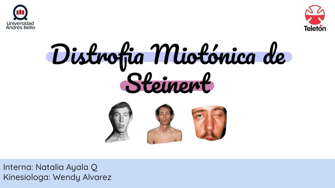 Distrofia Miotónica de Steinert