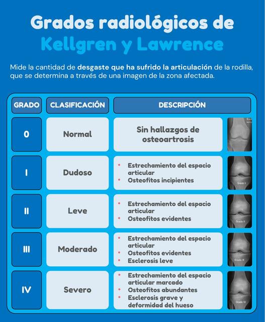Escala De Kellgren Y Lawrence _ Kellgren and Lawrence system for ...