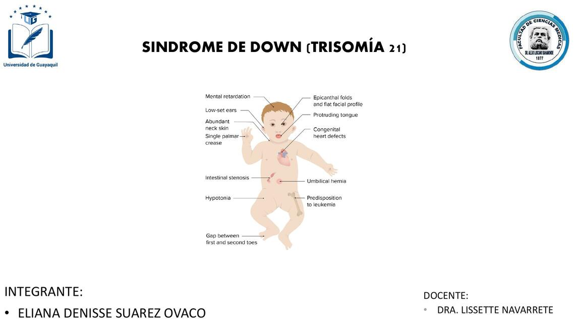 Síndrome de Down 