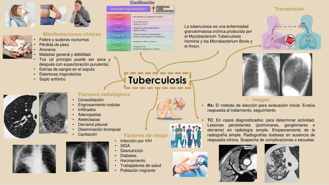 Tuberculosis