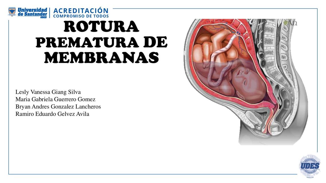 Rotura Prematura de Membranas