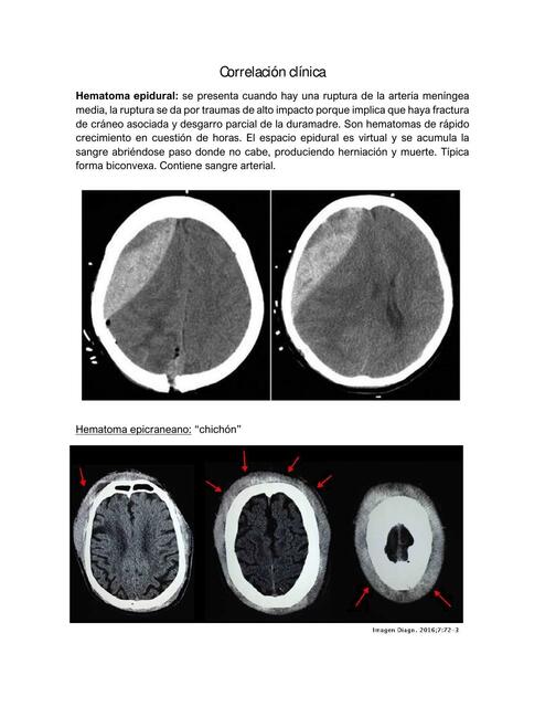 Correlación clínica meninges ventriculos LCR