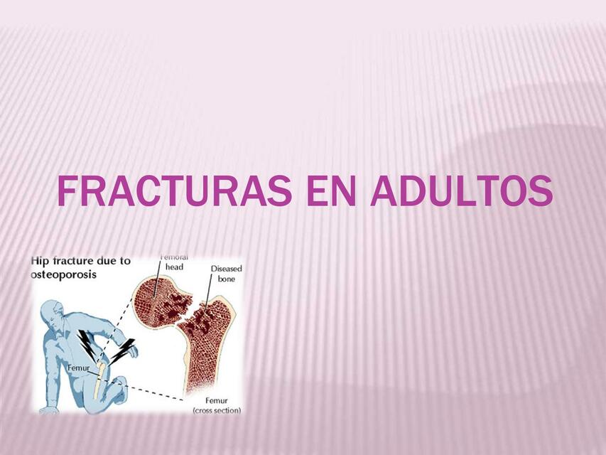 Fracturas en adultos 