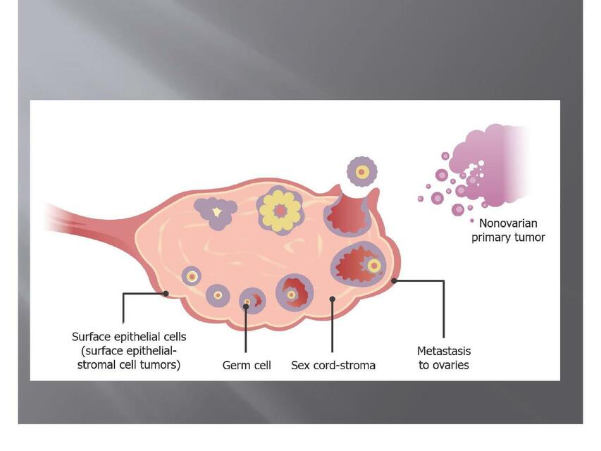 Tumores malignos de ovario 