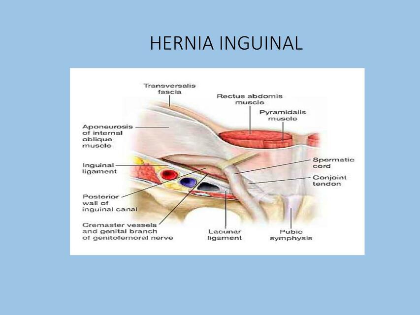 Hernia inguinal