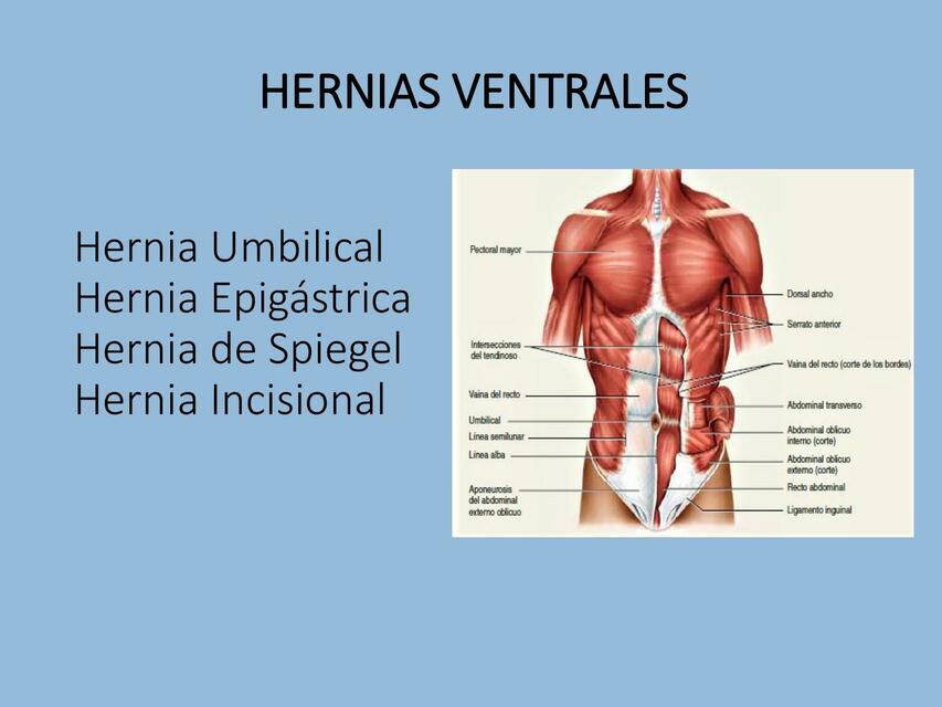 Hernias ventrales