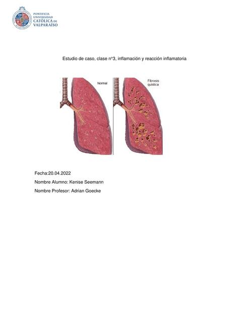 Inflamación y Reacción Inflamatoria 