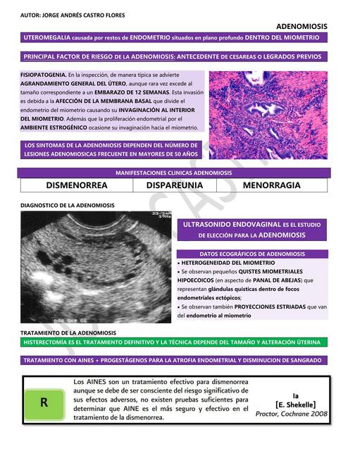 Adenomiosis