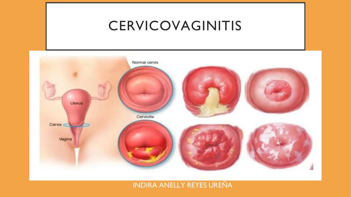 Cervicovaginitis 