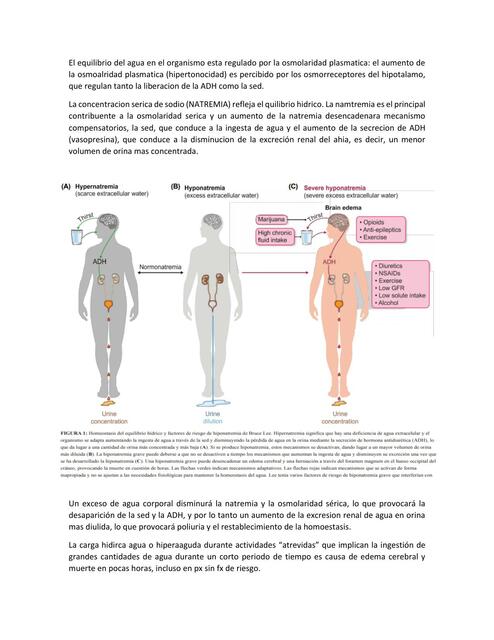 Hiponatremia 