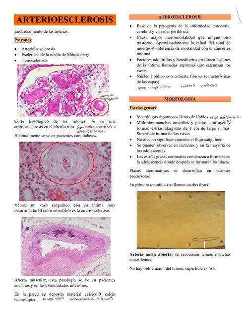 Arterioesclerosis