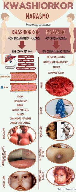 Kwashiorkor y Marasmo