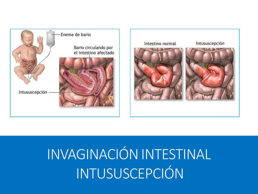 Invaginacion intestinal