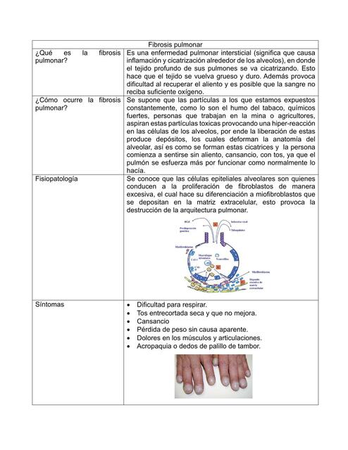 Fibrosis pulmonar 