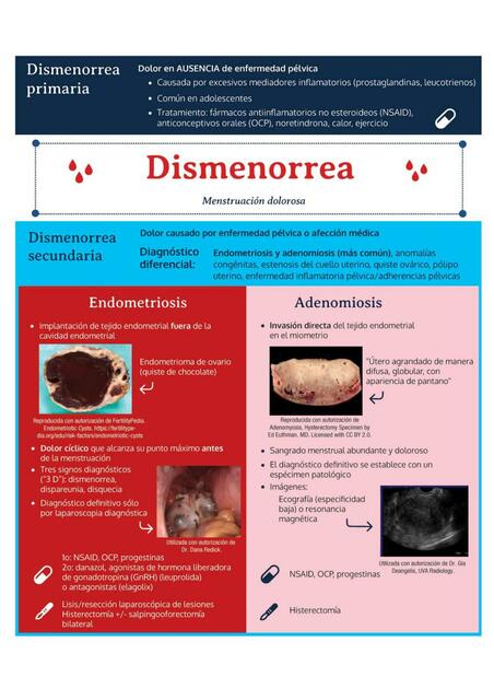 Dismenorrea uDocz
