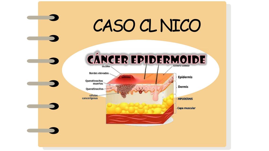 Cáncer Epidermoide 